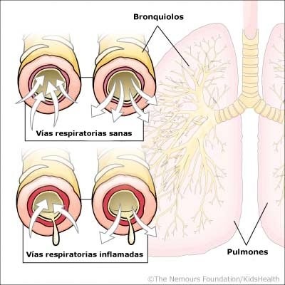 Mi bebé tiene bronquiolitis