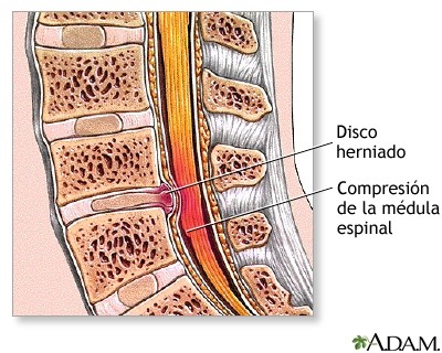 Hernia discal: Qué es, Tipos, Causas y Tratamiento