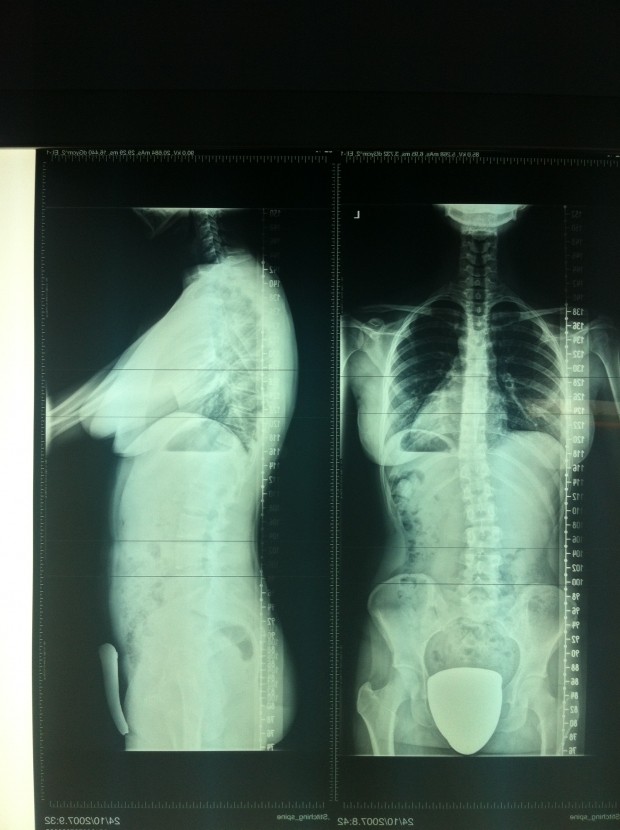 Tratamiento de escoliosis en niños con reeducación postural global