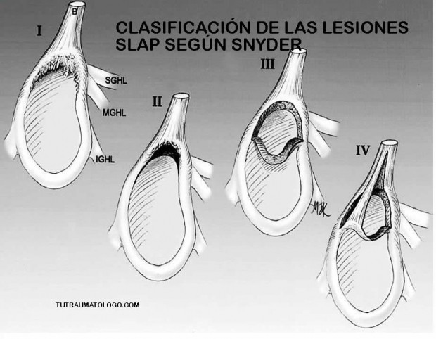 DOLOR DE HOMBRO: LESIÓN SLAP. FISIOTERAPIA Y REHABILITACIÓN