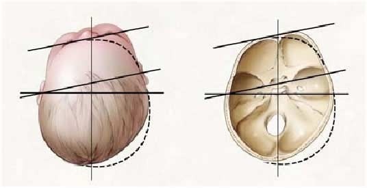 CASO CLÍNICO. PLAGIOCEFALIA. FISIOTERAPIA Y OSTEOPATÍA