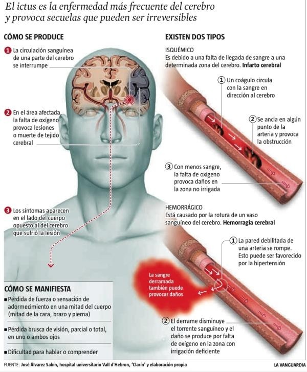 ACCIDENTE CEREBROVASCULAR o ICTUS