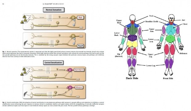 Fibromialgia: fisioterapia y rehabilitación