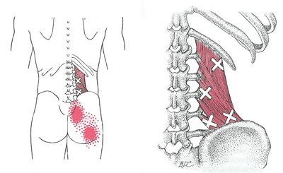 DOLOR LUMBAR CRÓNICO Y PUNCIÓN SECA