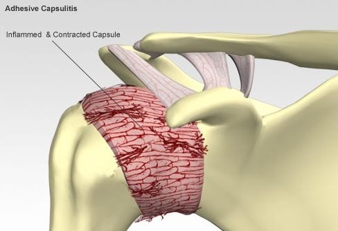 CAPSULITIS ADHESIVA DE HOMBRO