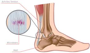 TENDINOSIS – TENDINITIS ROTULIANA: EJERCICIO EXCÉNTRICO COMO ALTERNATIVA A LA CIRUGÍA