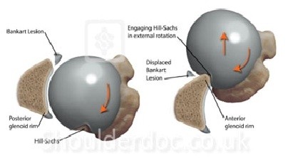 FISIOTERAPIA Y REHABILITACIÓN: LESIÓN DE HILL SACHS