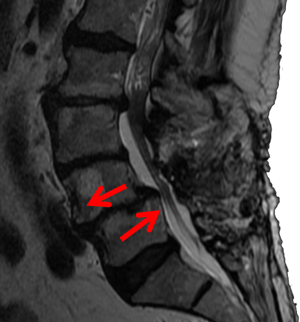 PRESCRIPCIÓN DEL EJERCICIO FÍSICO PARA EL TRATAMIENTO DE LA OSTEOPOROSIS (PARTE I)