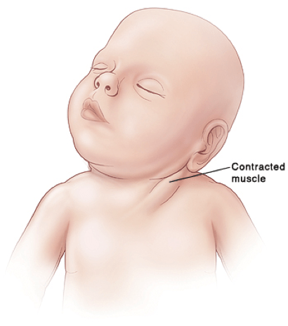 TORTÍCOLIS CONGÉNITA. FISIOTERAPIA Y OSTEOPATÍA