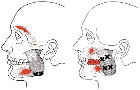 ARTICULACIÓN ATM TEMPOROMANDIBULAR Y DOLOR CRÓNICO