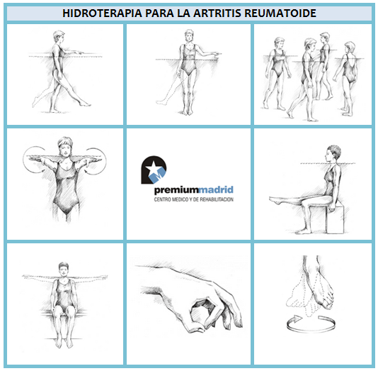 EJERCICIO EN EL AGUA, HIDROTERAPIA Y ARTRITIS REUMATOIDE