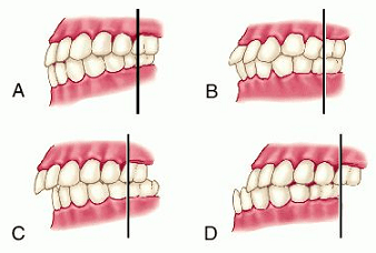 FISIOTERAPIA OROFACIAL: OCLUSIÓN Y MALOCLUSION