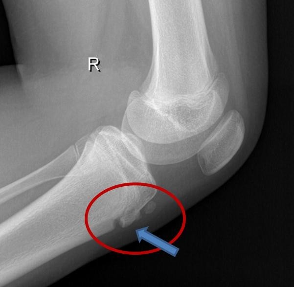 Enfermedad de Osgood – Schlatter. Fisioterapia y rehabilitación