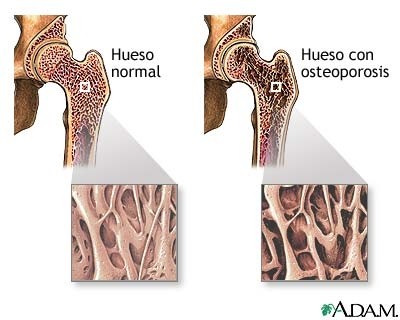 VIVIR CON OSTEOPOROSIS