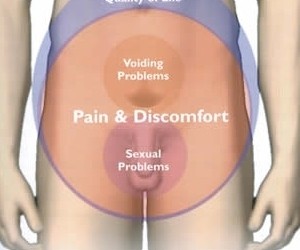 PROSTATITIS CRÓNICA ¿CÓMO IDENTIFICAR SUS SÍNTOMAS?