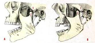 FISIOTERAPIA OROFACIAL: SUBLUXACIÓN CONDILAR