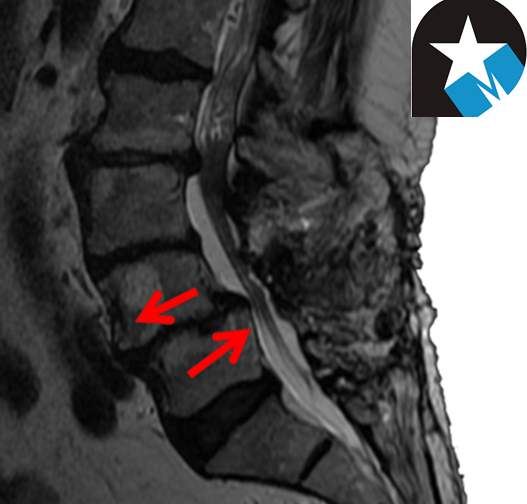 ESPONDILOLISTESIS LUMBAR