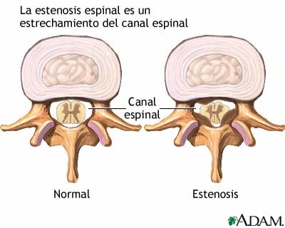 ¿En qué consiste mi diagnóstico de estenosis de canal lumbar?