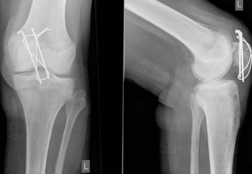 Tratamiento quirúrgico en la fractura de rótula