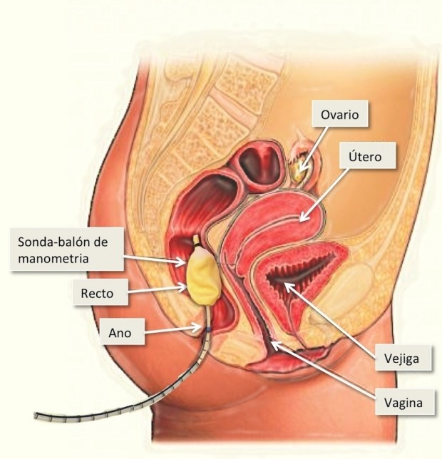 Fisioterapia en coloproctología: incontinencia fecal