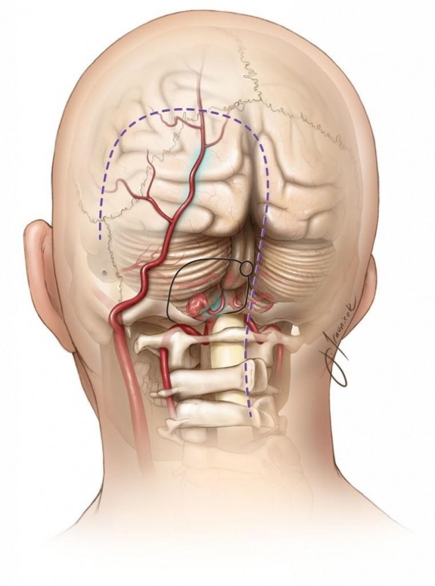 Neuralgia de Arnold ¿Qué es?