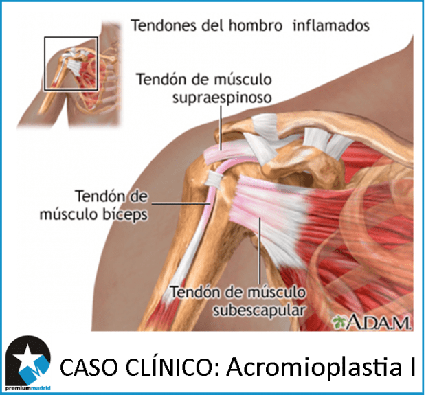 Caso clínico: ACROMIOPLASTIA I