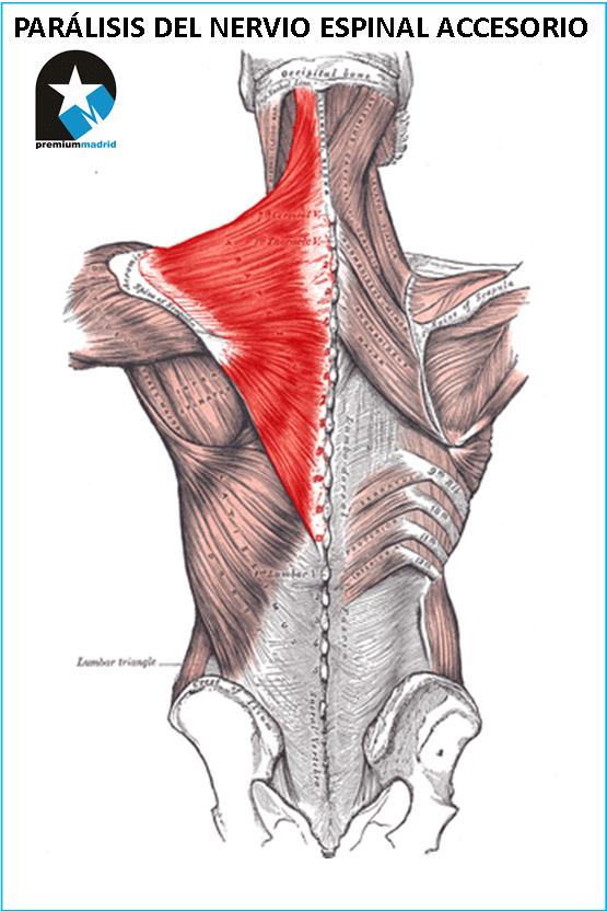 PARÁLISIS ESPINAL ACCESORIO.