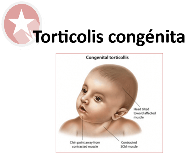 TORTICOLIS CONGENITA: INCIDENCIA Y TRATAMIENTO PRECOZ