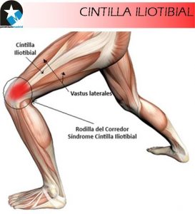 síndrome de la cintilla iliotibial