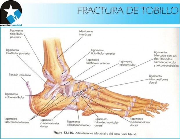 Caso Clínico: Recuperación de antigua FRACTURA DE TOBILLO en accidente