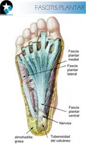 fascitis plantar