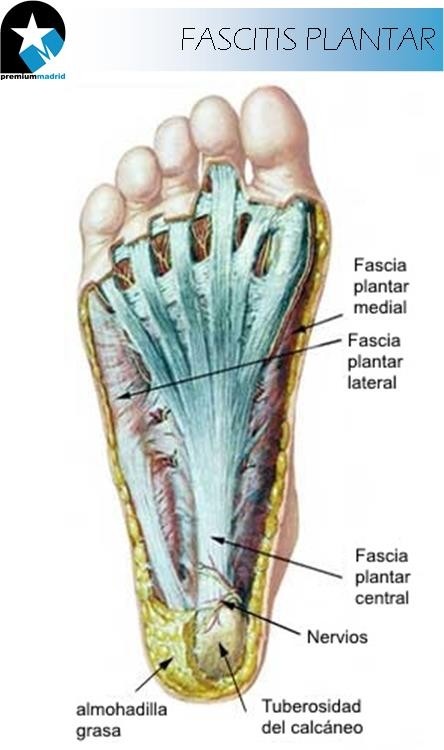 ¿Qué es la fascitis plantar? Síntomas y Tratamientos