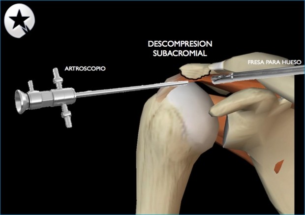 Caso Clínico: ACROMIOPLASTIA II