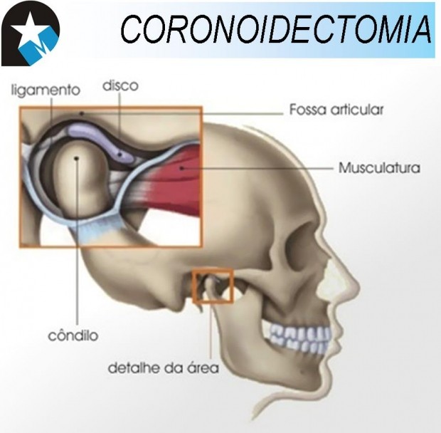 Caso Clínico CORONOIDECTOMIA.