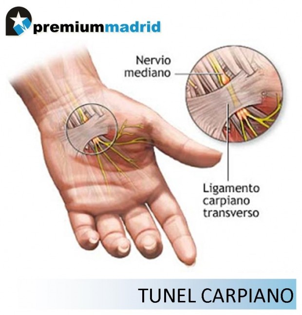 Síndrome del Túnel Carpiano en Ciclistas