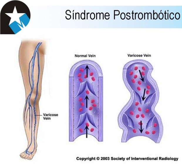 Síndrome postrombótico