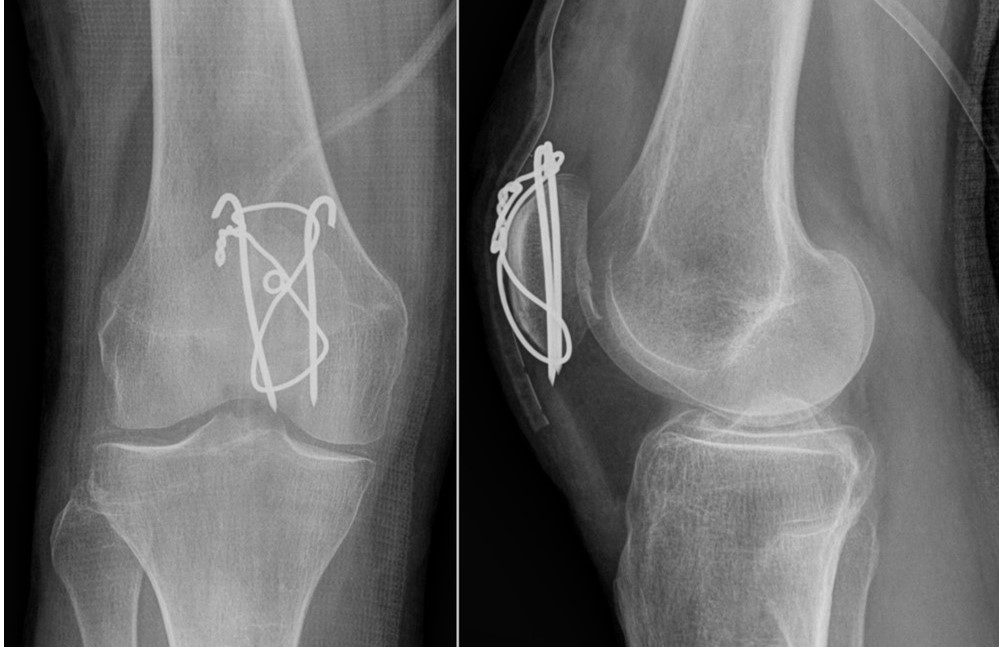 Fracturas de Rótula: causas, diagnóstico, tratamiento