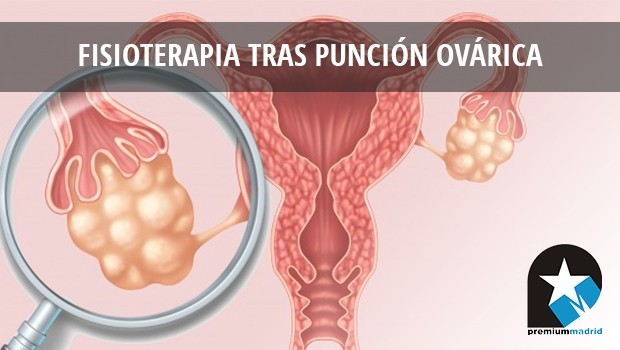 Caso clínico: fisioterapia tras punción ovárica