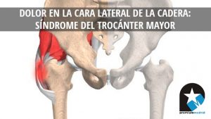 Sindrome del trocanter mayor