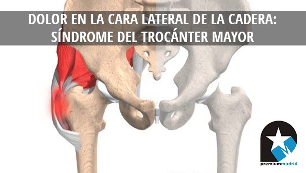 Dolor en la cara lateral de la cadera: Síndrome del trocánter mayor