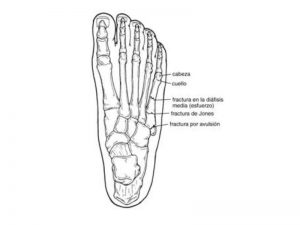 fractura-quinto-metatarsiano