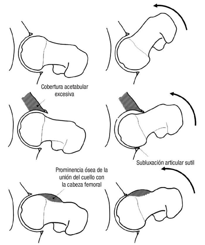 CHOQUE FEMOROACETABULAR, QUÉ ES 2