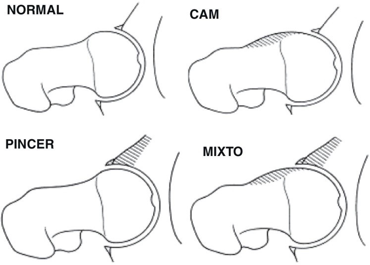 CHOQUE FEMOROACETABULAR, QUÉ ES