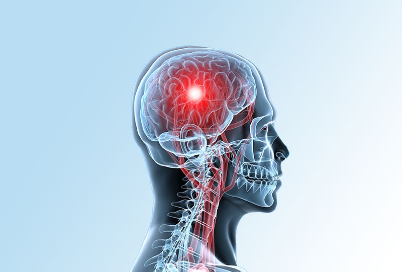 Ictus o accidente cerebrovascular