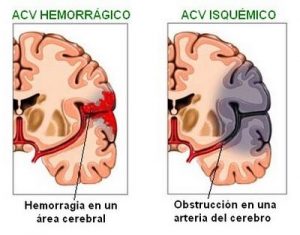 Ictus o accidente cerebrovascular