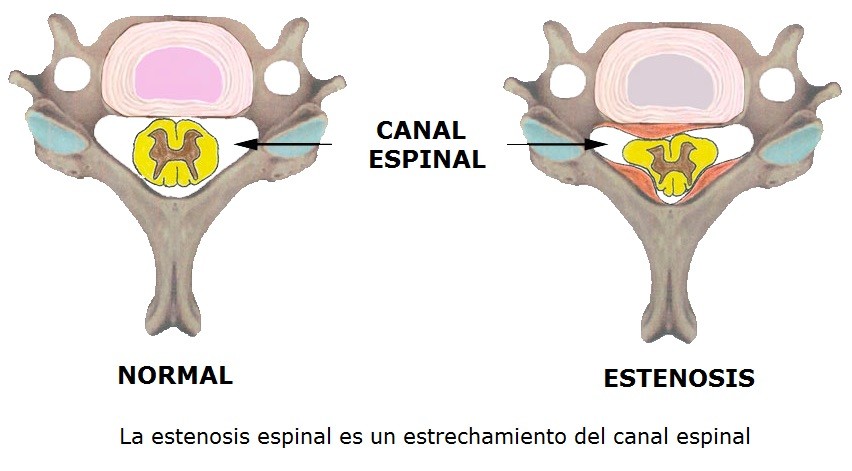 Abordaje de la fisioterapia en la estenosis del canal lumbar