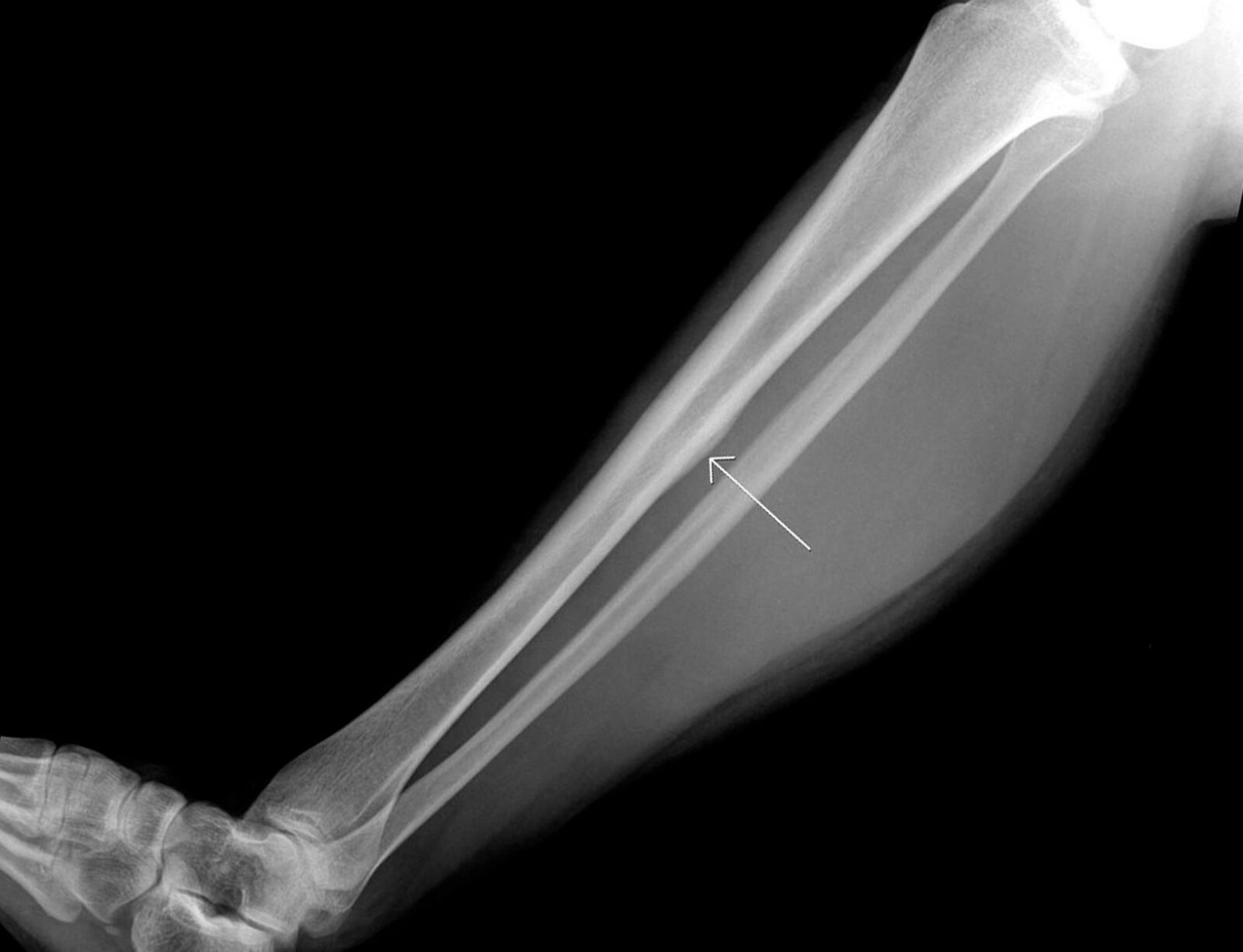 Fracturas por estrés de la tibia