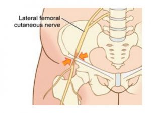 Meralgia Parestésica Premium Health & Sport