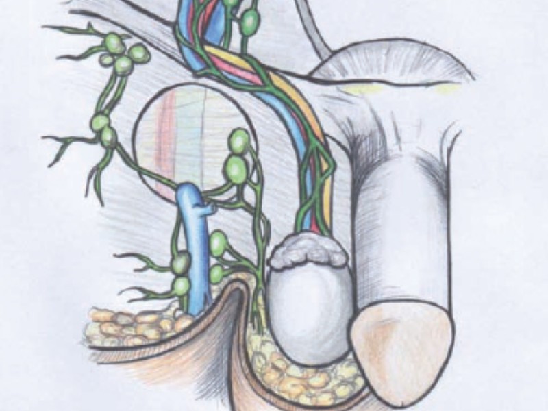 DLM Intracavitario para patología de suelo pélvico