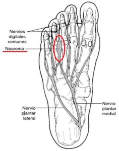 localización del neuroma de morton 